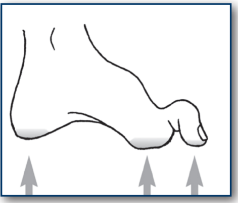 קובץ:רגל סוכרתית איור1.png