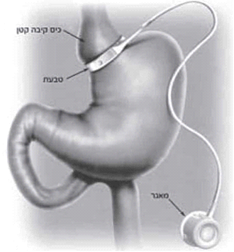 קובץ:Bariatric64.png