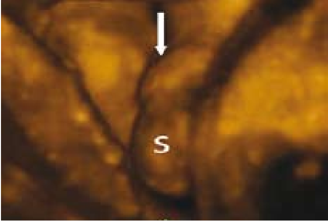 קובץ:Fetal sex14.png