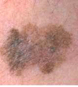 Melanoma-02.png