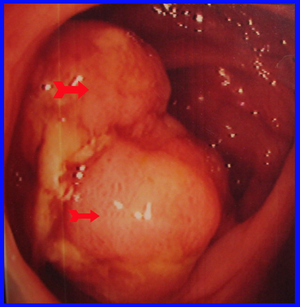 קובץ:Adenocarcinoma1.png