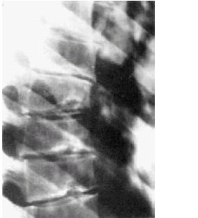 קובץ:מחלת שרמן.jpg