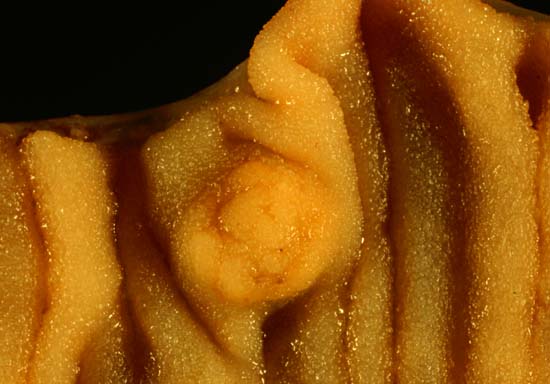 קובץ:Multiple Carcinoid Tumors of the Small Bowel 2.jpg