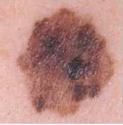 Melanoma-03.png