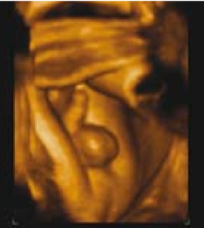 קובץ:Fetal sex12.png