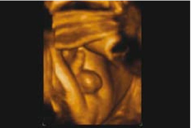 קובץ:Fetal sex9.png