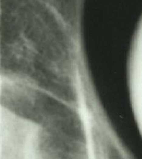 Cervical pregnancy2.jpg