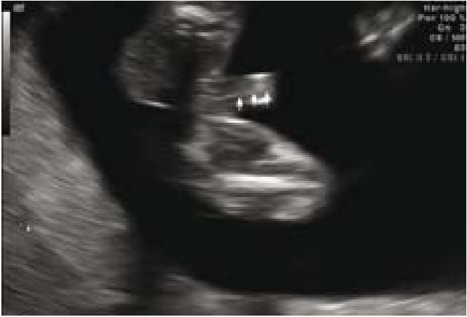 קובץ:Fetal sex6.png