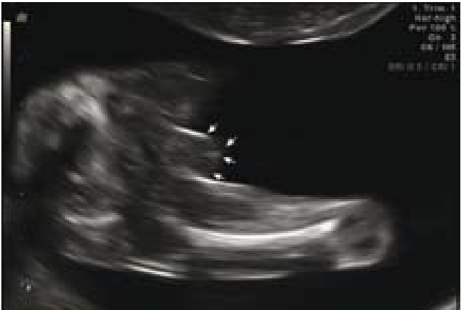 קובץ:Fetal sex3.png