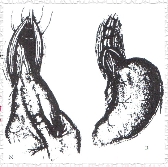 קובץ:Paraesophageal4.png