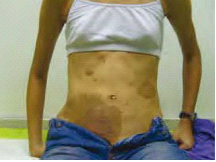 קובץ:Neurofibromatosis 1.png