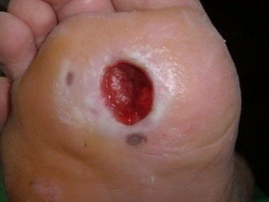 קובץ:כיב נוירופתי.jpg