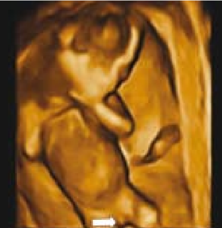 קובץ:Fetal sex11.png