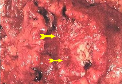 קובץ:Gastriccarcinoma123.jpg