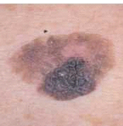 Melanoma-01.png