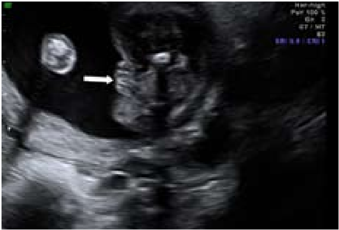 קובץ:Fetal sex5.png