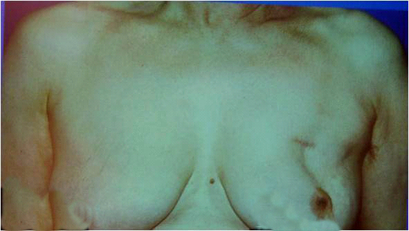 קובץ:Breastcancer4512d.png