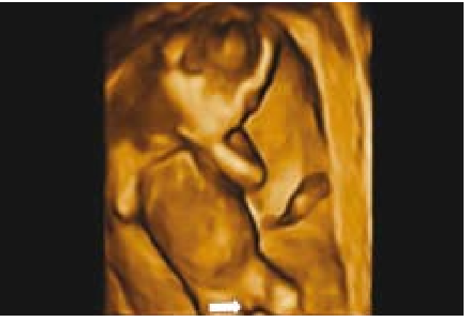 קובץ:Fetal sex7.png