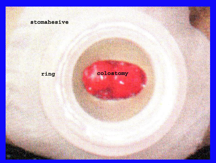קובץ:Intestinalstoma5.jpg