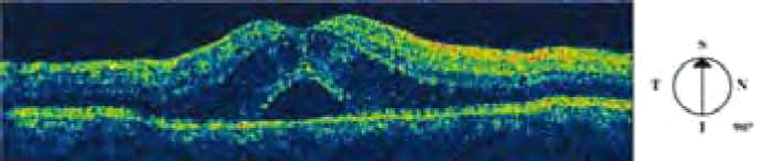 קובץ:Neuroretinitis4.png