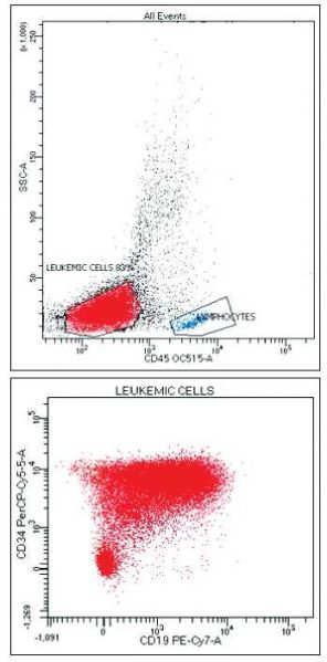 קובץ:לימפובלסטית 2.jpg