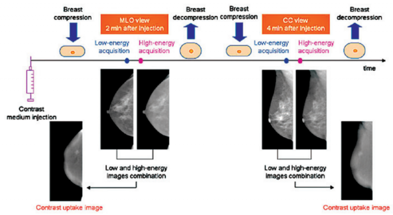 קובץ:ממוגרפיה עם חומר ניגוד.png