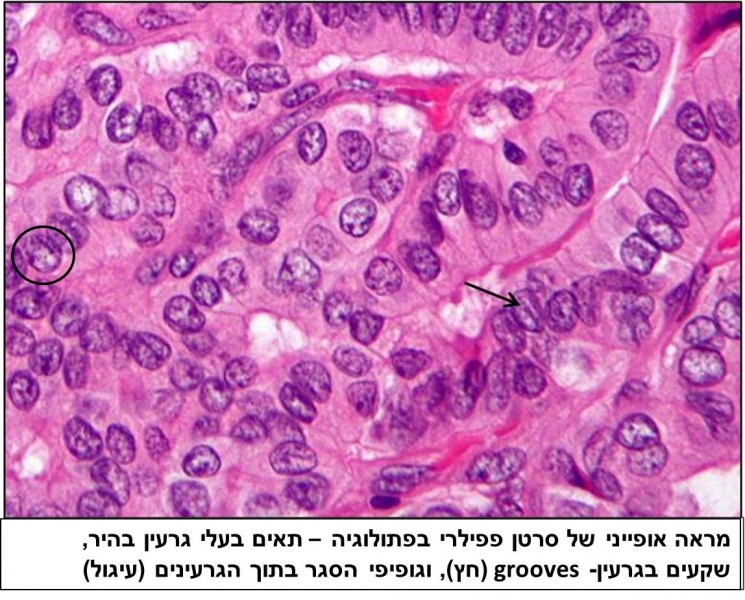 קובץ:Papillary thyroid carcinoma.jpg