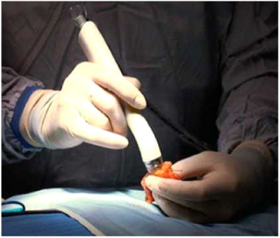איור מס' 3 : מדידה תוך ניתוחית של תכשיר למפקטומי בעזרת MarginProbe
