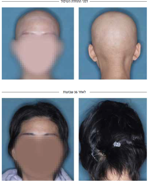 קובץ:Alopecia2.png