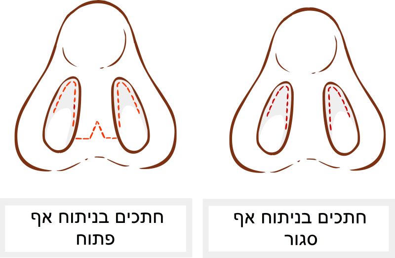קובץ:חתכים בניתוח אף.jpg