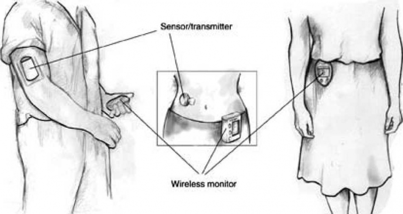 קובץ:משאבת אינסולין2.png