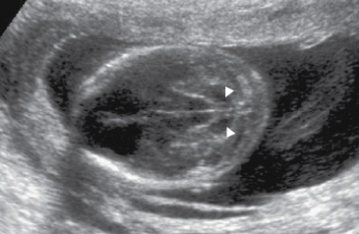 ונטריקולומגליה 2.png