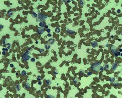 Marrow Follicullar lymphoma.jpg