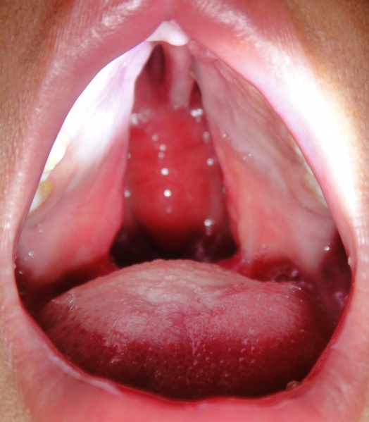קובץ:Cleft palate incom.JPG