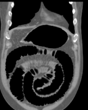 Gallstonelleus448a.jpg