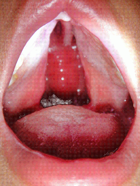 קובץ:חיך חלקי.GIF