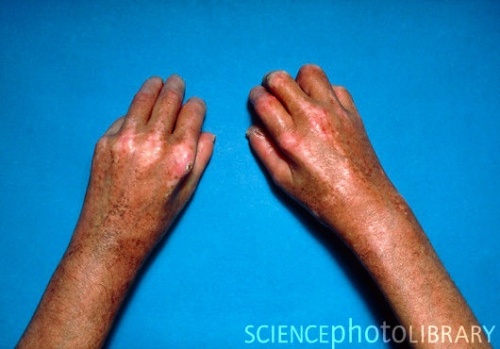 Sclerodactyly.jpg