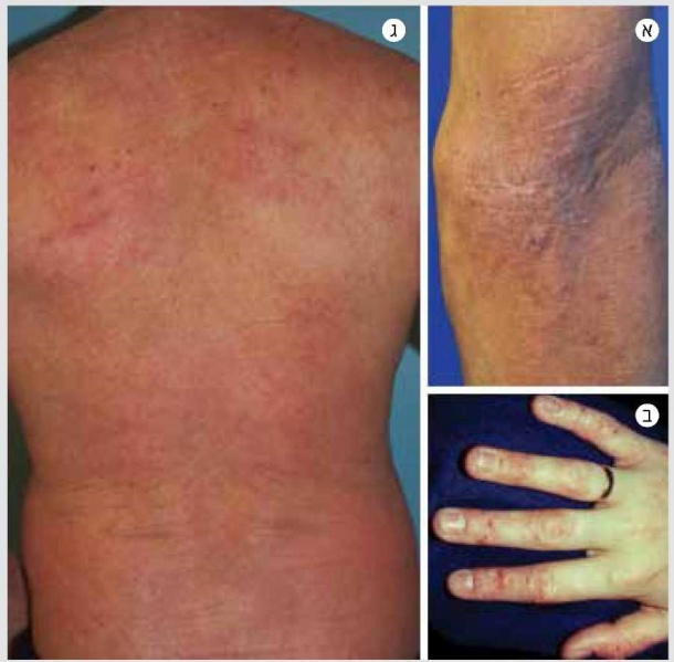 קובץ:דדרמטיטיס 1.jpg