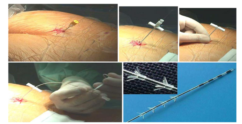 קובץ:Overactive bladder8.png