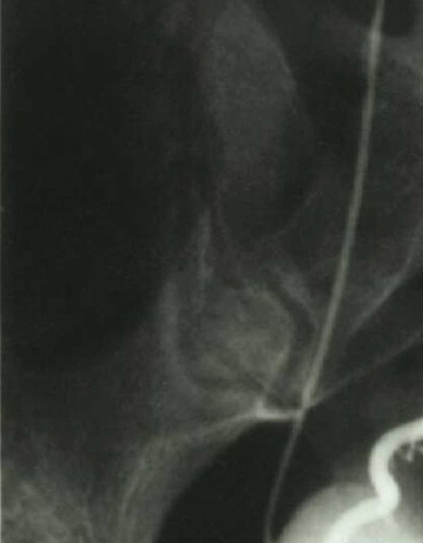 Cervical pregnancy1.jpg