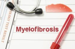 Myelofibrosis1.jpg