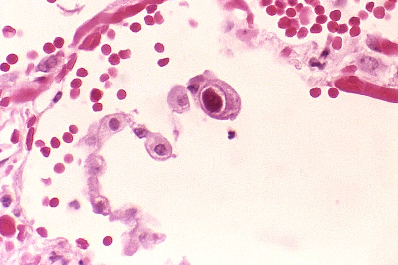 קובץ:Cytomegalovirus 01.jpg