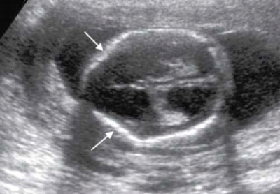 ונטריקולומגליה 1.png