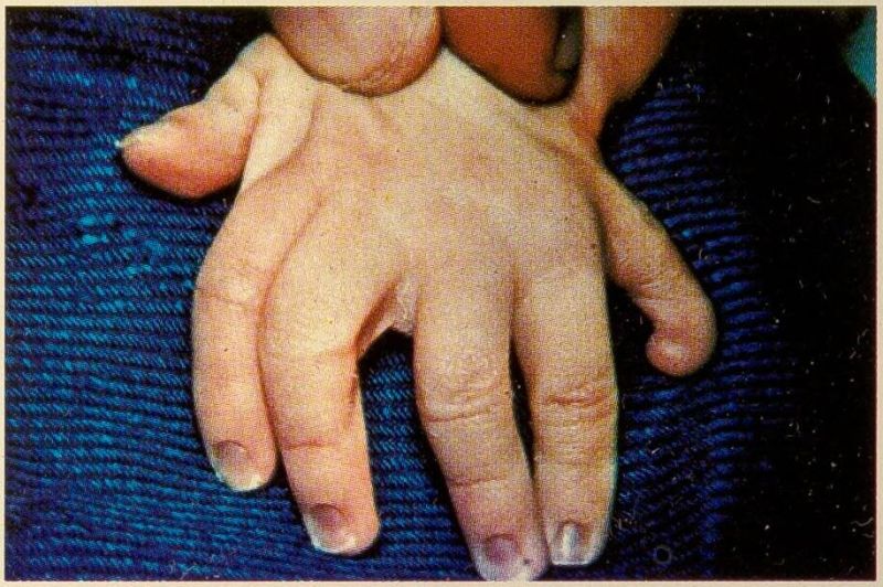 קובץ:Smith-Lemli-Opitz Syndrome 5.jpg