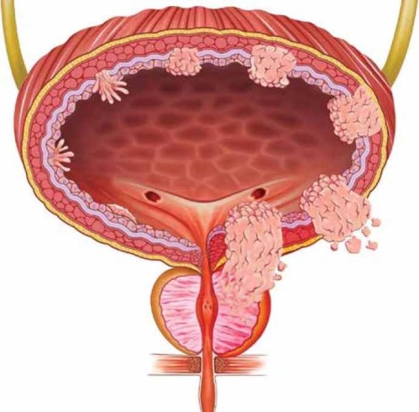 קובץ:סרטן שלפוחית 1.jpg