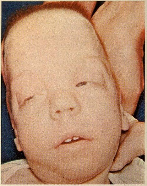 קובץ:Smith-Lemli-Opitz Syndrome 1.jpg