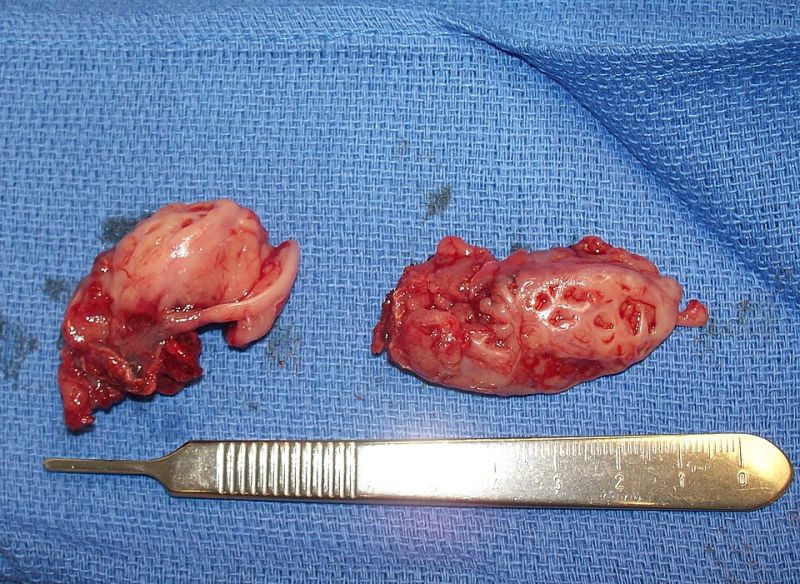 קובץ:Pair of Removed Tonsils.JPG